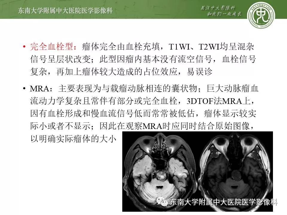 【病例】基底动脉巨大动脉瘤伴血栓形成1例CT及MR