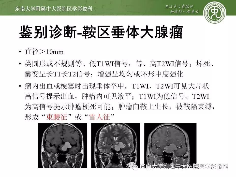 【病例】基底动脉巨大动脉瘤伴血栓形成1例CT及MR