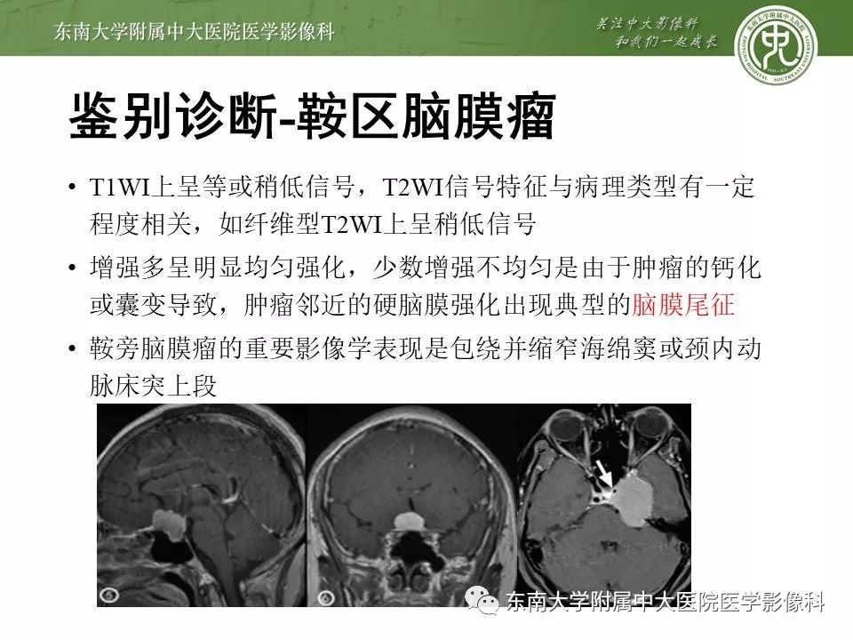 【病例】基底动脉巨大动脉瘤伴血栓形成1例CT及MR