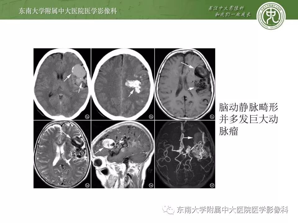 【病例】基底动脉巨大动脉瘤伴血栓形成1例CT及MR