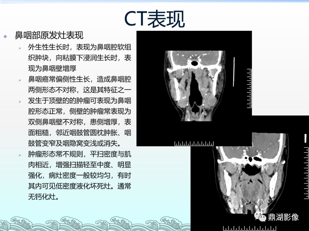 【PPT】鼻咽癌的CT诊断与鉴别诊断