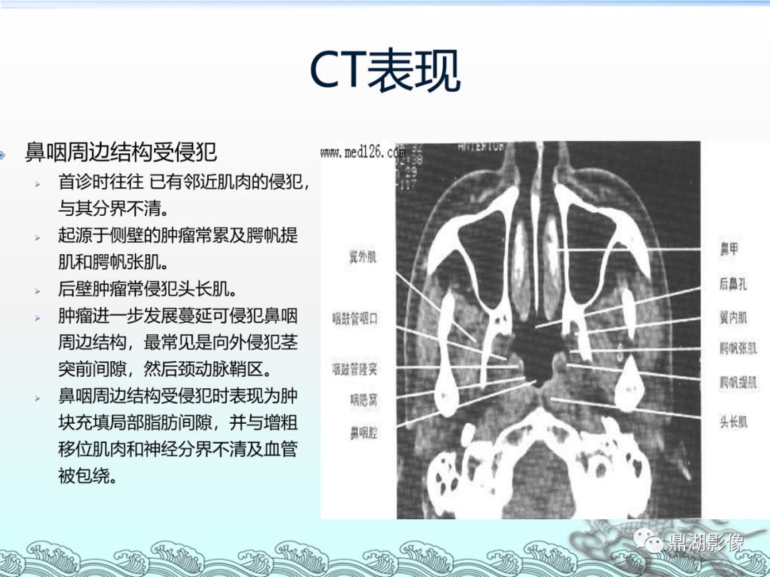 【PPT】鼻咽癌的CT诊断与鉴别诊断