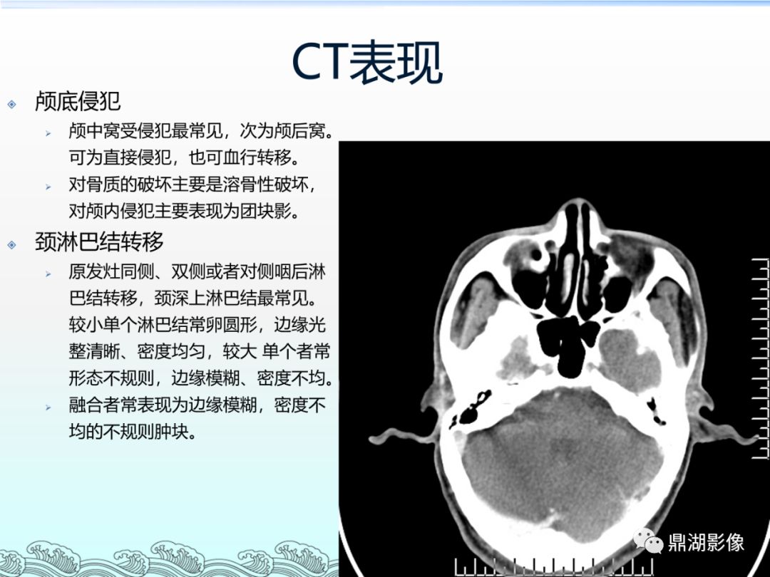 【PPT】鼻咽癌的CT诊断与鉴别诊断