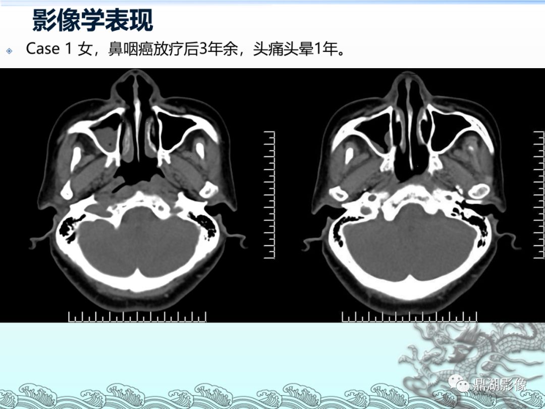 【PPT】鼻咽癌的CT诊断与鉴别诊断