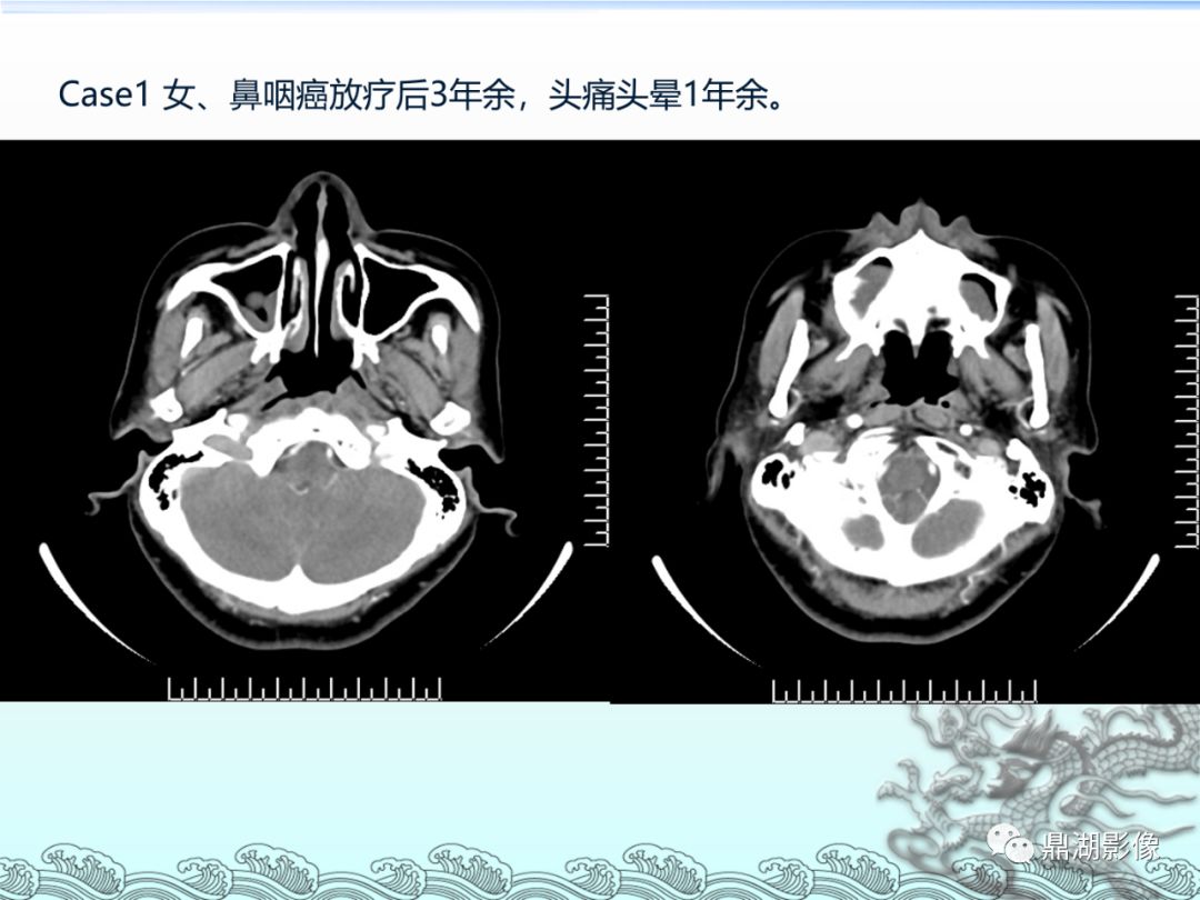 【PPT】鼻咽癌的CT诊断与鉴别诊断