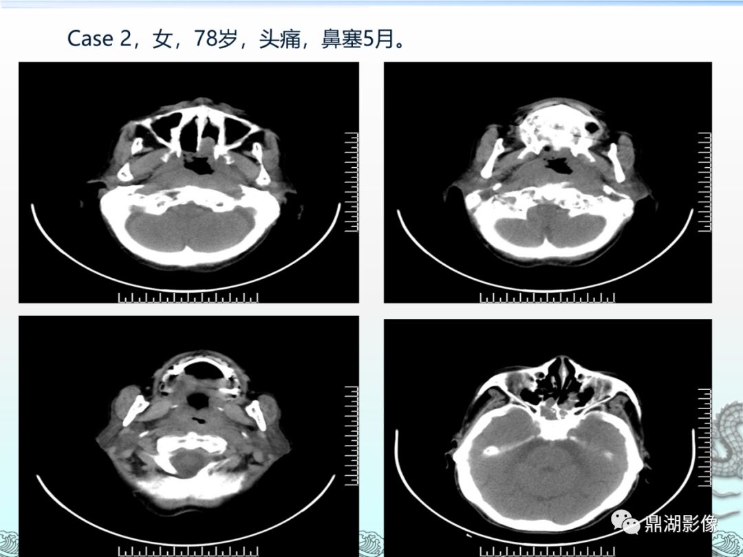 【PPT】鼻咽癌的CT诊断与鉴别诊断