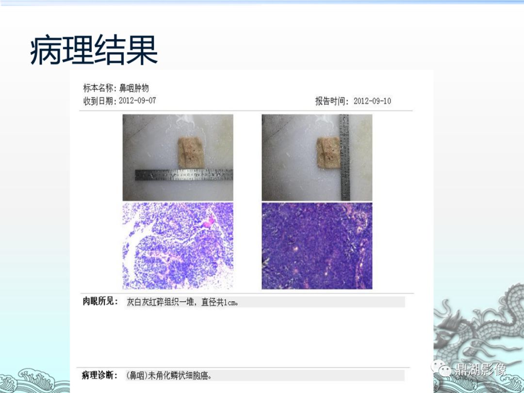 【PPT】鼻咽癌的CT诊断与鉴别诊断