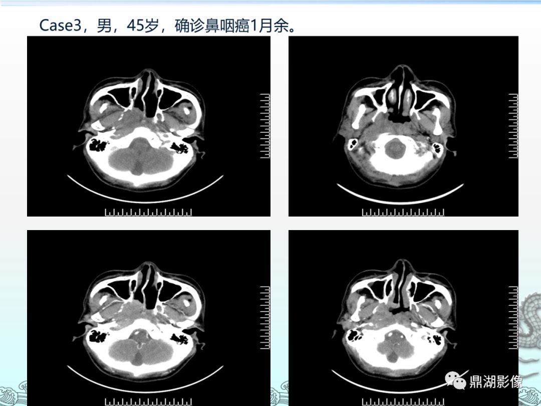 【PPT】鼻咽癌的CT诊断与鉴别诊断