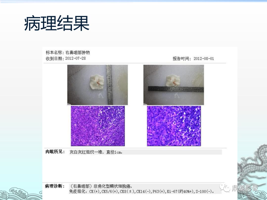 【PPT】鼻咽癌的CT诊断与鉴别诊断