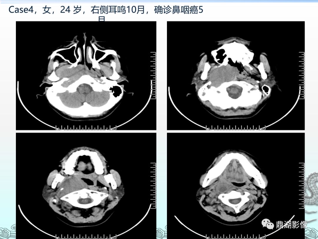 【PPT】鼻咽癌的CT诊断与鉴别诊断