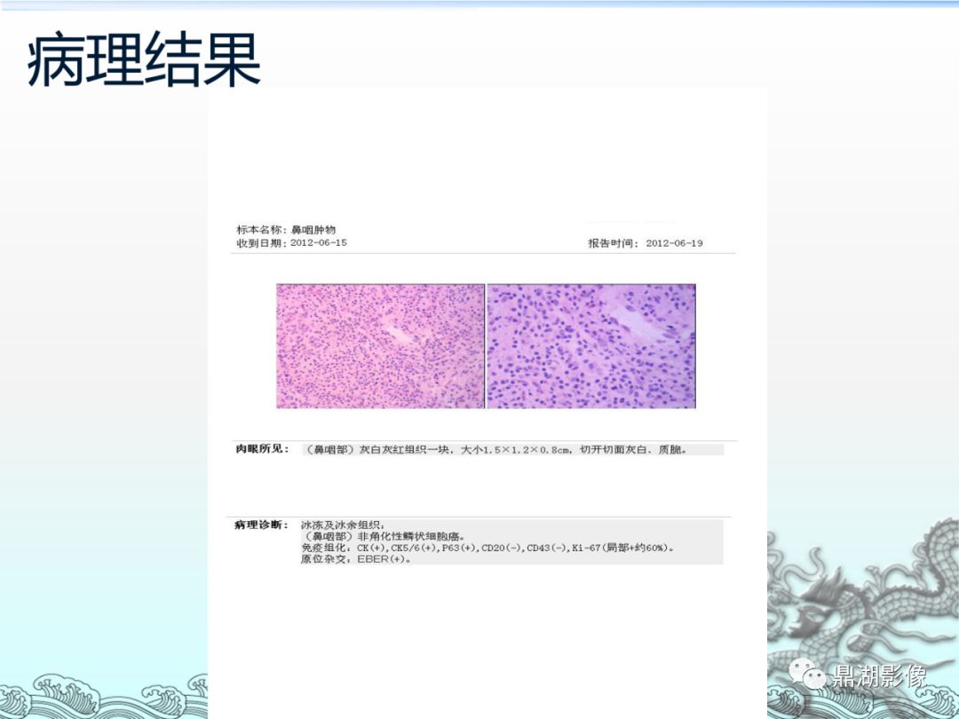 【PPT】鼻咽癌的CT诊断与鉴别诊断