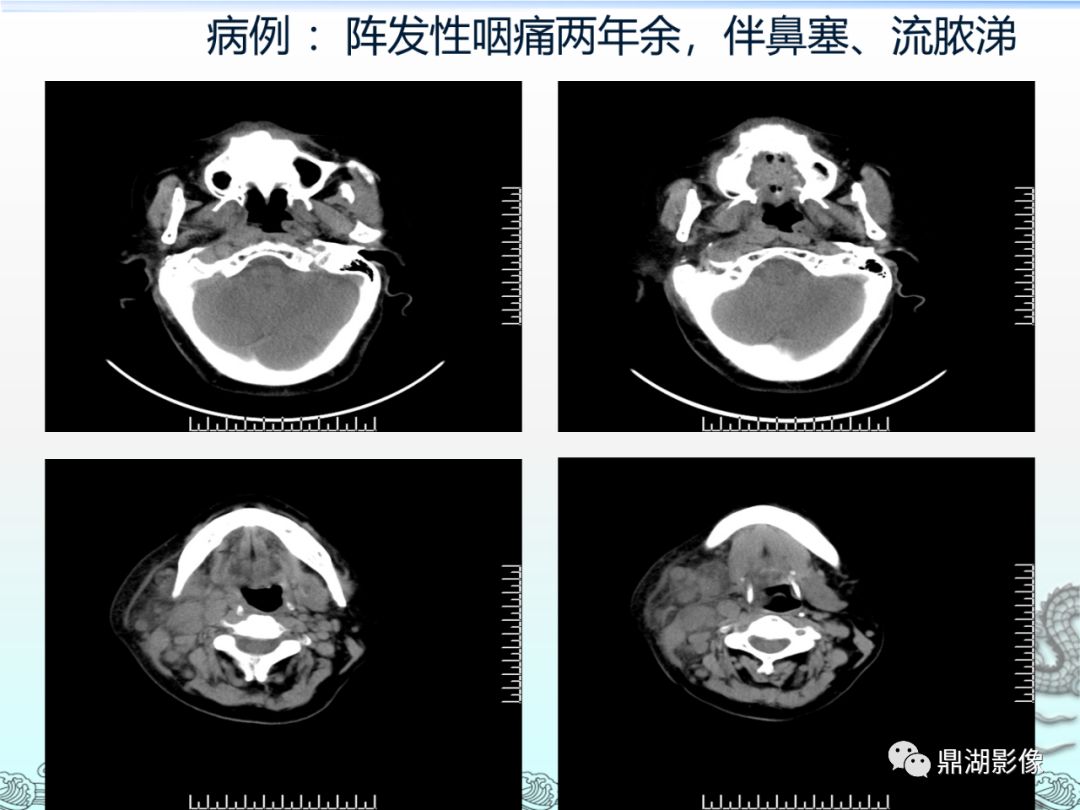 【PPT】鼻咽癌的CT诊断与鉴别诊断