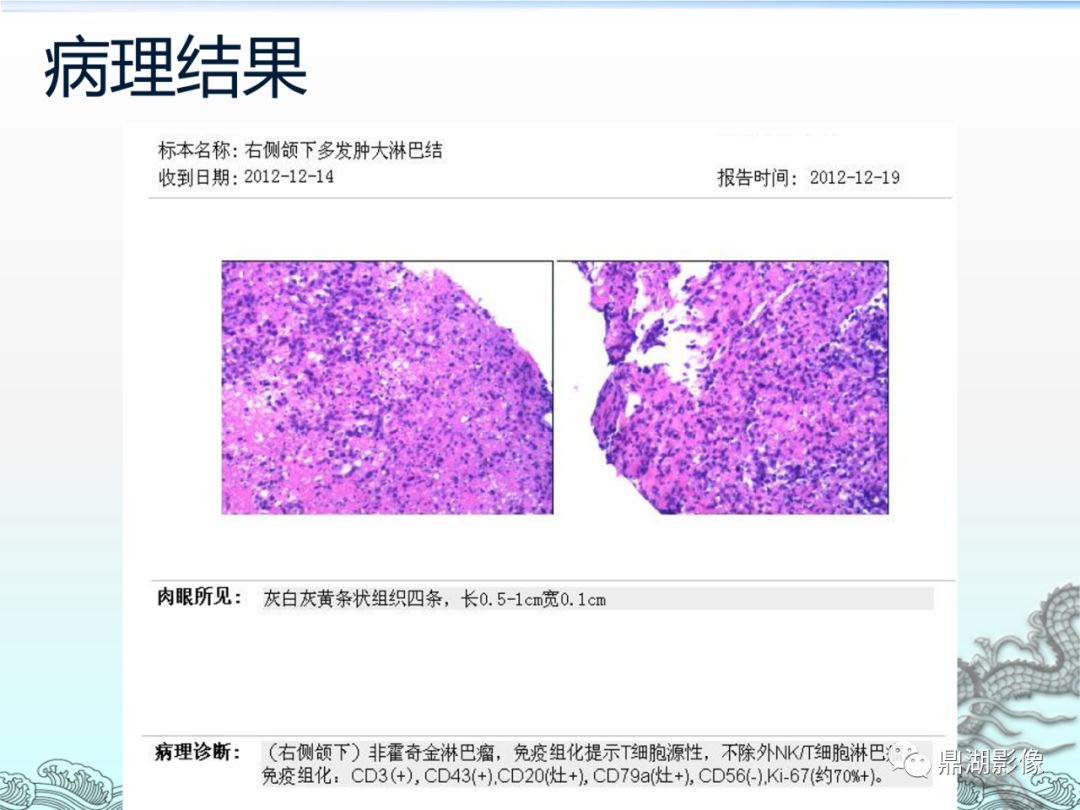 【PPT】鼻咽癌的CT诊断与鉴别诊断