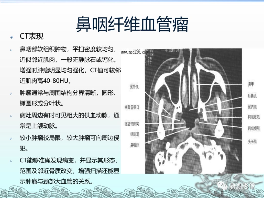 【PPT】鼻咽癌的CT诊断与鉴别诊断