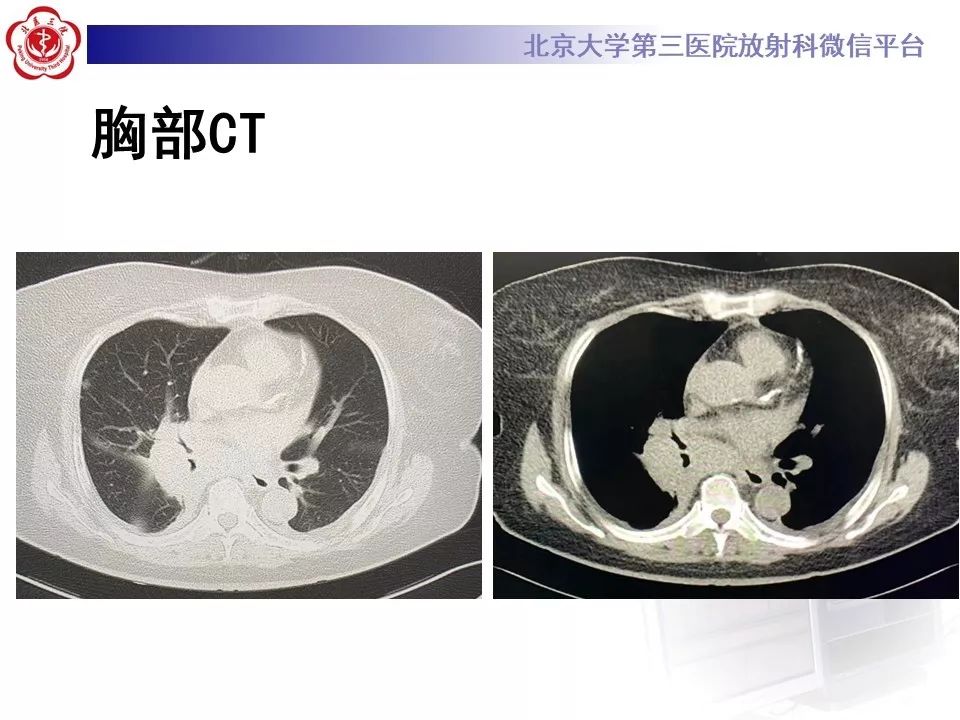 【病例】肺部组织细胞肉瘤例CT