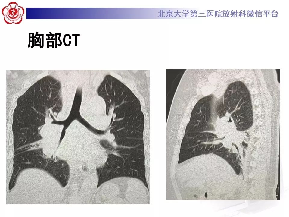 【病例】肺部组织细胞肉瘤例CT