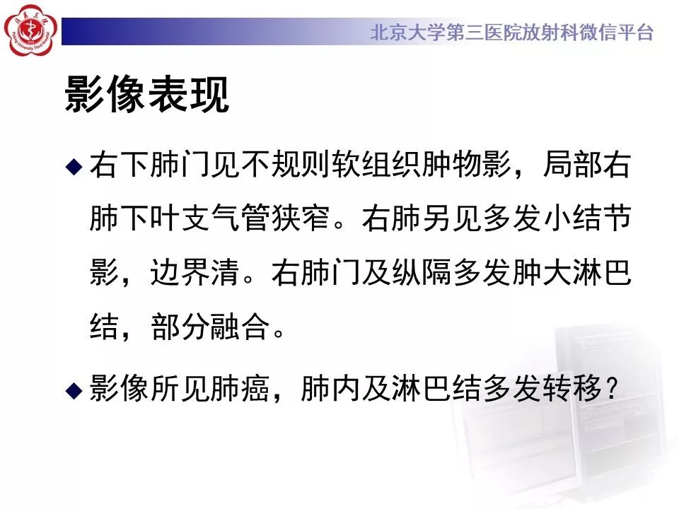 【病例】肺部组织细胞肉瘤例CT