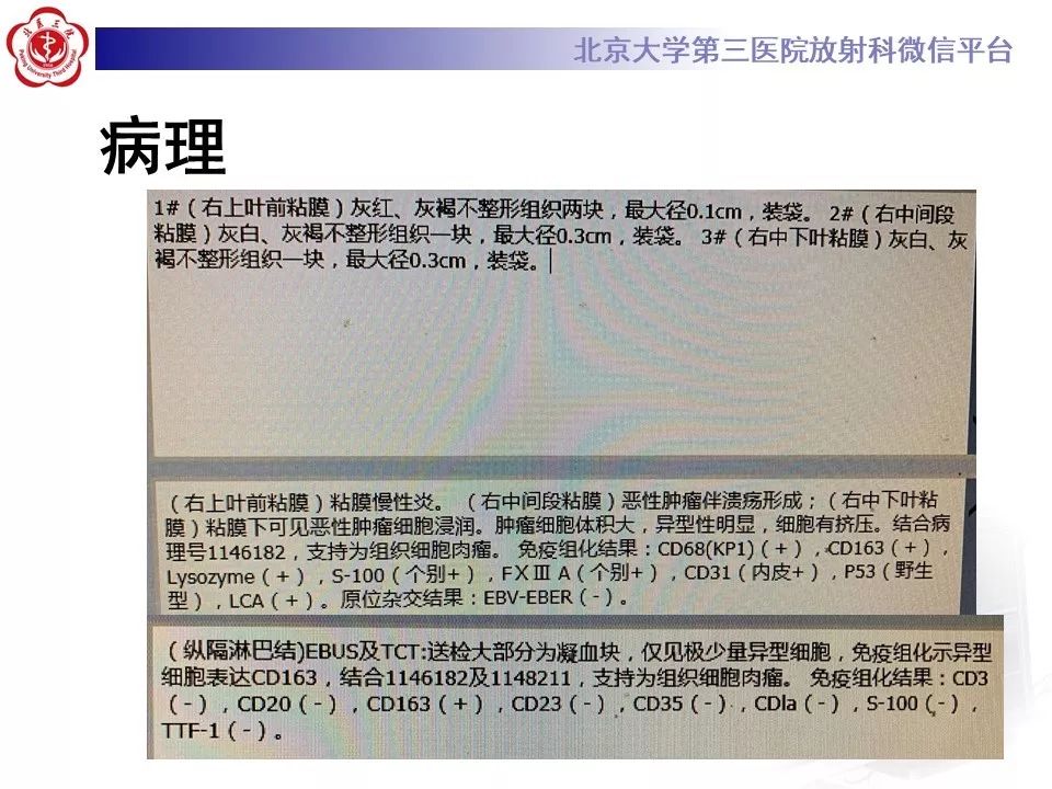 【病例】肺部组织细胞肉瘤例CT