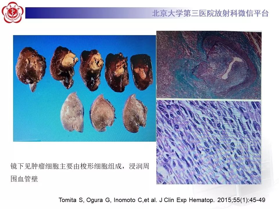 【病例】肺部组织细胞肉瘤例CT