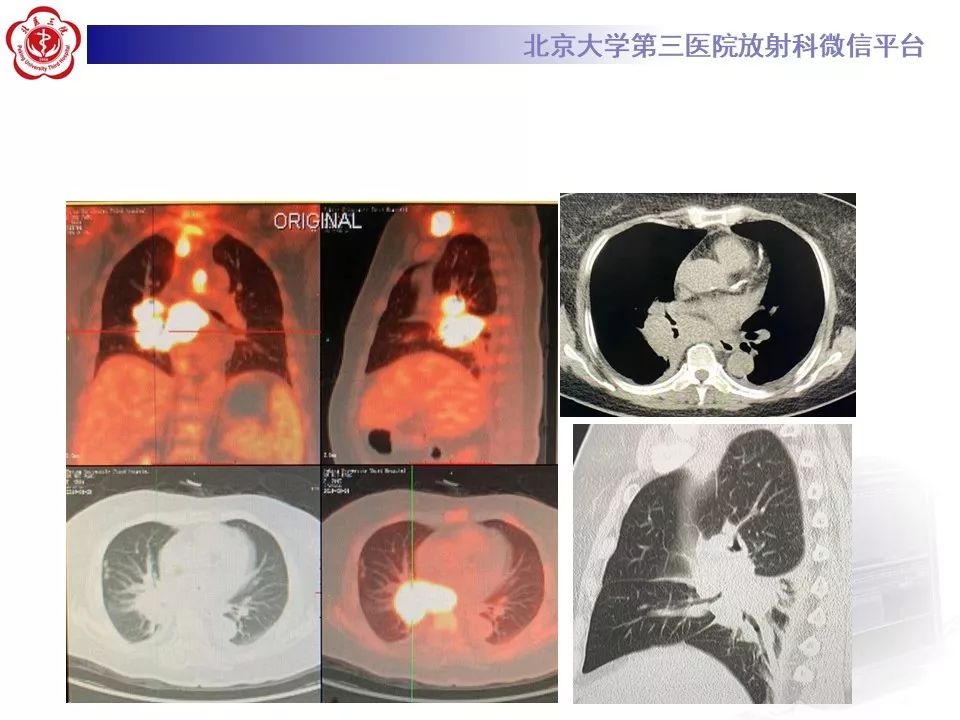 【病例】肺部组织细胞肉瘤例CT