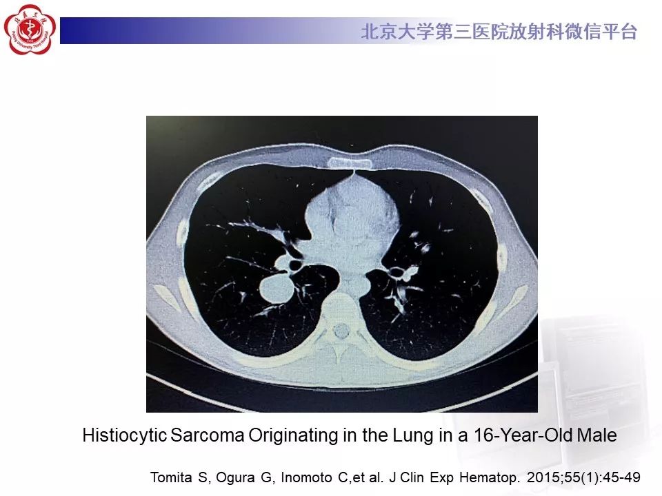 【病例】肺部组织细胞肉瘤例CT