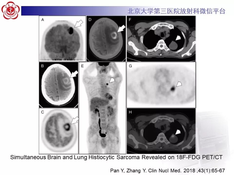 【病例】肺部组织细胞肉瘤例CT