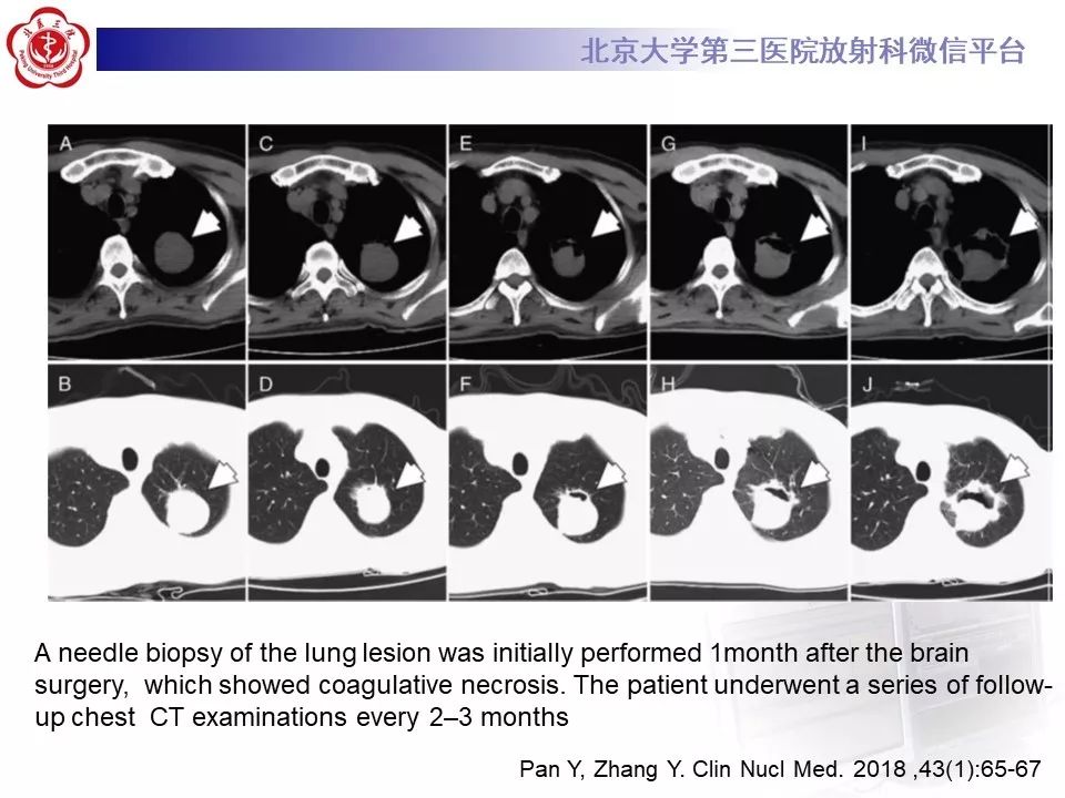 【病例】肺部组织细胞肉瘤例CT