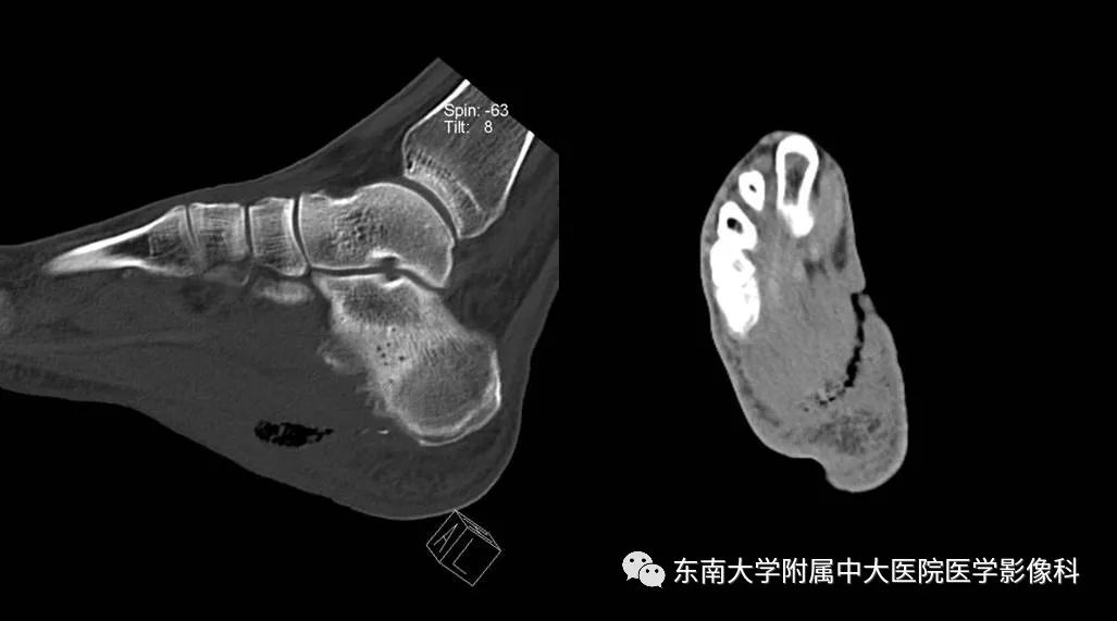 【病例】糖尿病足3例X线CT及MR影像 【病例】糖尿病足3例X线CT及MR影像