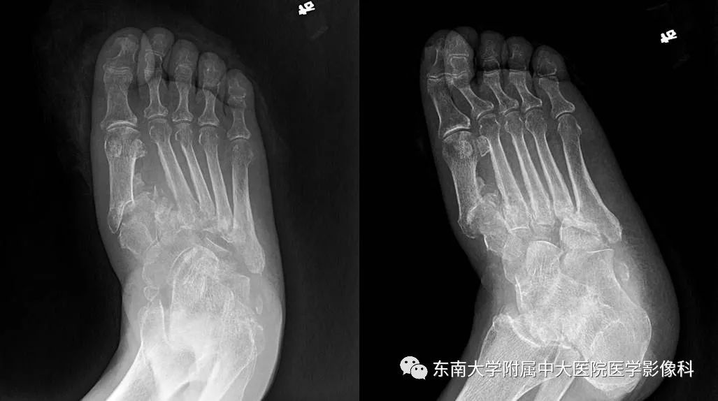 【病例】糖尿病足3例X线CT及MR影像 【病例】糖尿病足3例X线CT及MR影像
