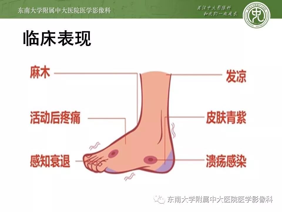 【病例】糖尿病足3例X线CT及MR影像 【病例】糖尿病足3例X线CT及MR影像