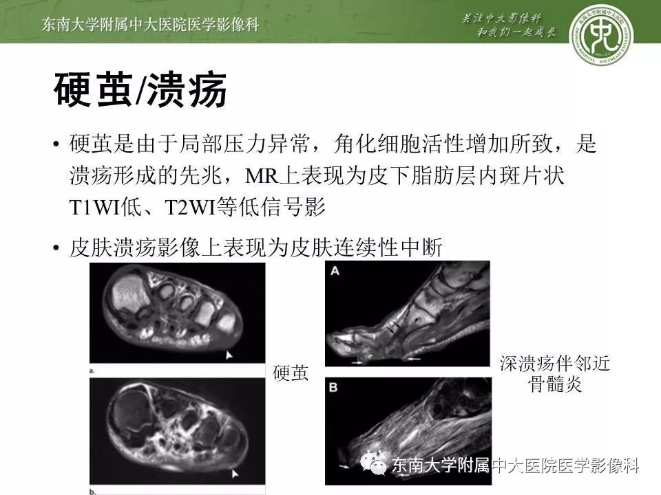 【病例】糖尿病足3例X线CT及MR影像 【病例】糖尿病足3例X线CT及MR影像