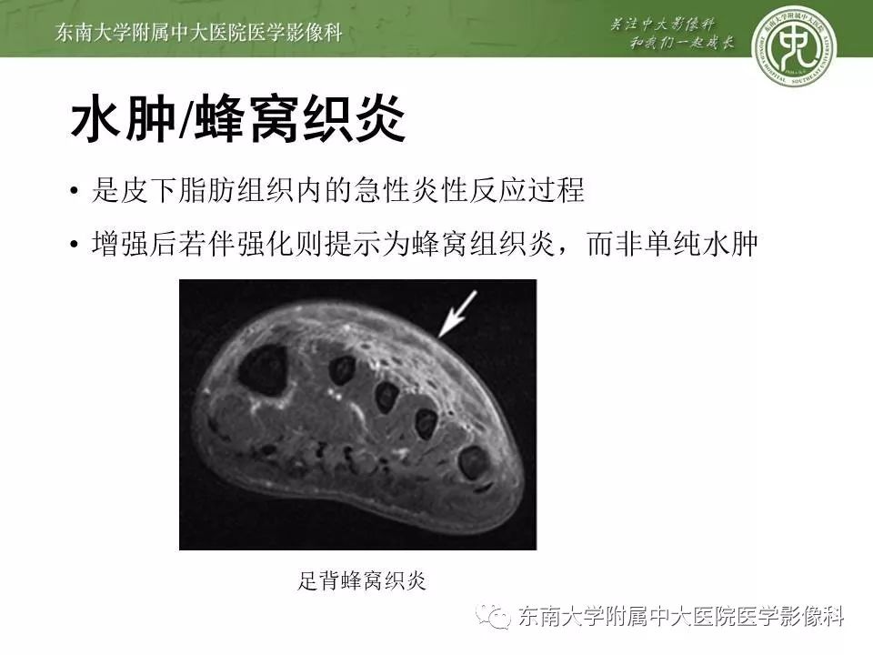 【病例】糖尿病足3例X线CT及MR影像 【病例】糖尿病足3例X线CT及MR影像