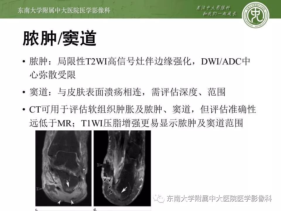 【病例】糖尿病足3例X线CT及MR影像 【病例】糖尿病足3例X线CT及MR影像