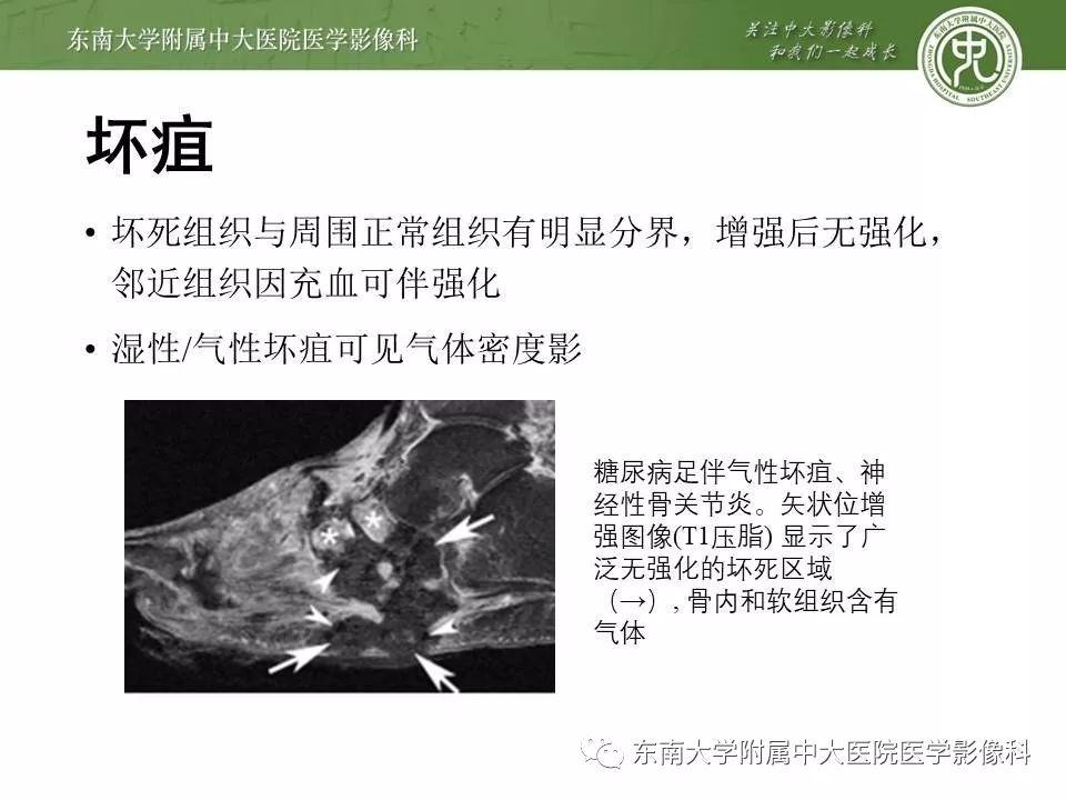 【病例】糖尿病足3例X线CT及MR影像 【病例】糖尿病足3例X线CT及MR影像