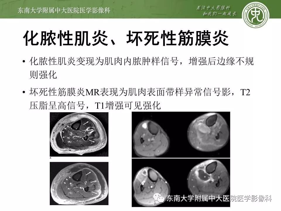 【病例】糖尿病足3例X线CT及MR影像 【病例】糖尿病足3例X线CT及MR影像