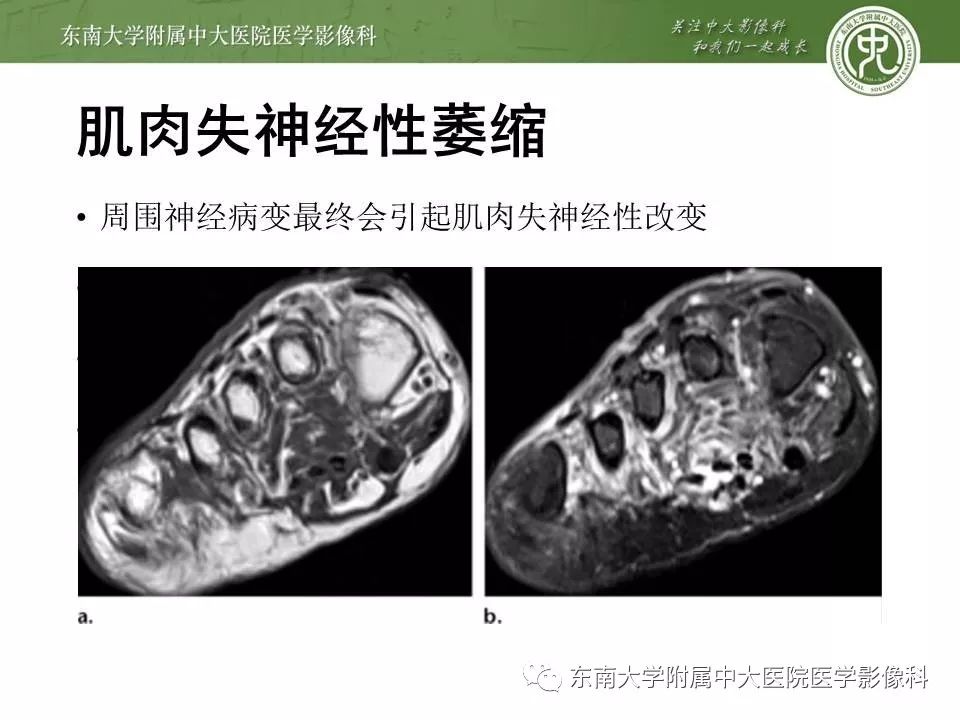 【病例】糖尿病足3例X线CT及MR影像 【病例】糖尿病足3例X线CT及MR影像