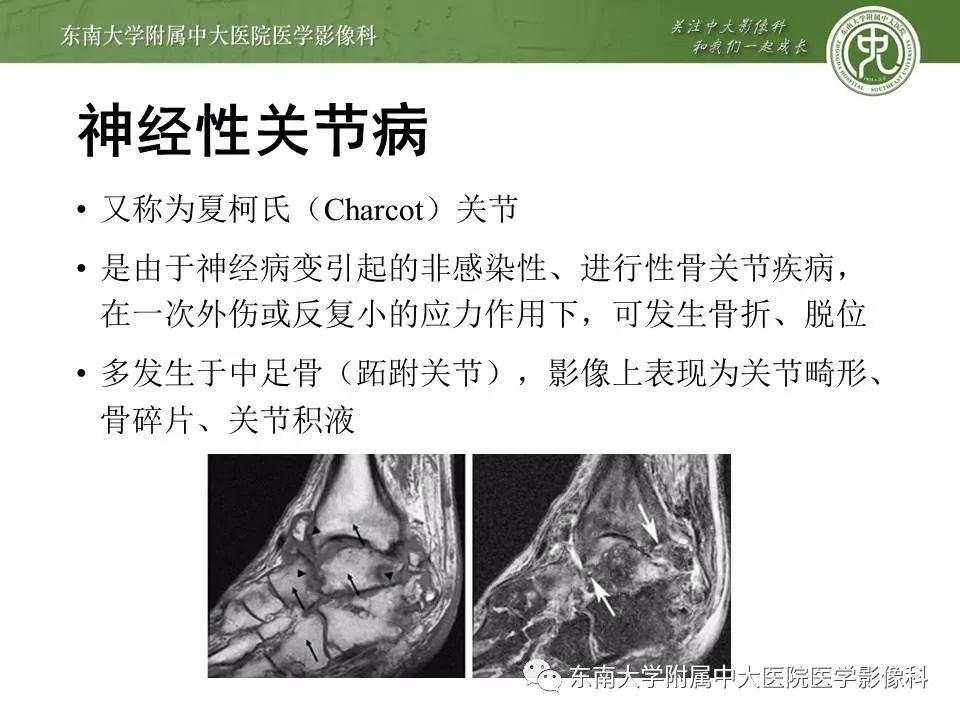 【病例】糖尿病足3例X线CT及MR影像 【病例】糖尿病足3例X线CT及MR影像