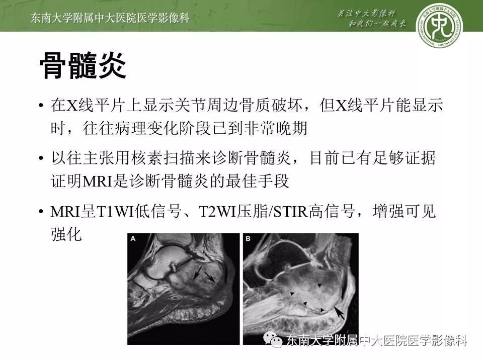 【病例】糖尿病足3例X线CT及MR影像 【病例】糖尿病足3例X线CT及MR影像