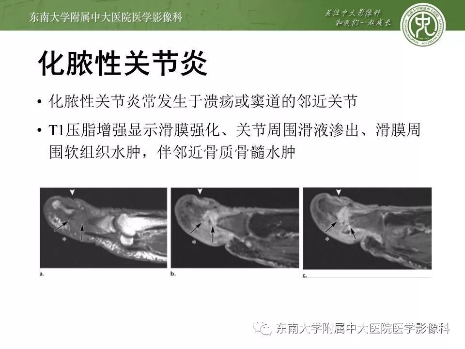 【病例】糖尿病足3例X线CT及MR影像 【病例】糖尿病足3例X线CT及MR影像