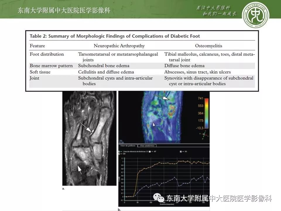 【病例】糖尿病足3例X线CT及MR影像 【病例】糖尿病足3例X线CT及MR影像