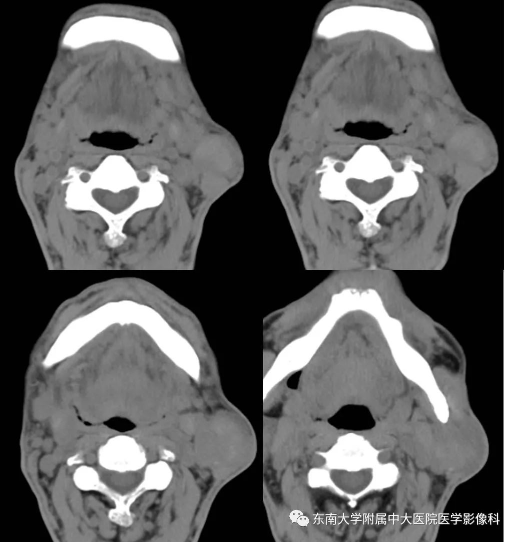 【病例】腮腺腺淋巴瘤1例CT及MR影像