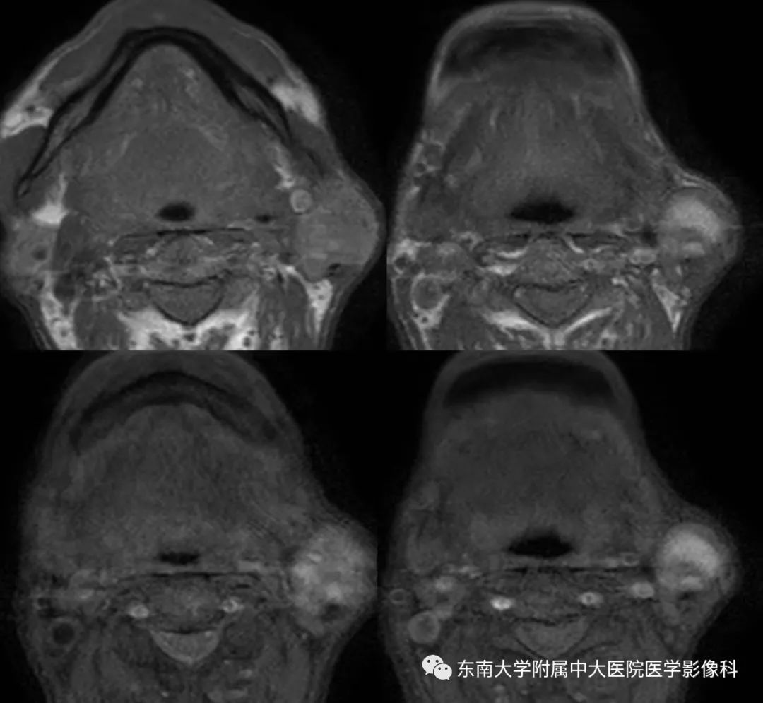【病例】腮腺腺淋巴瘤1例CT及MR影像