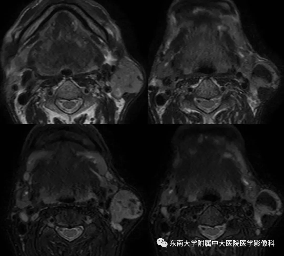 【病例】腮腺腺淋巴瘤1例CT及MR影像
