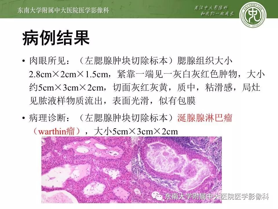 【病例】腮腺腺淋巴瘤1例CT及MR影像