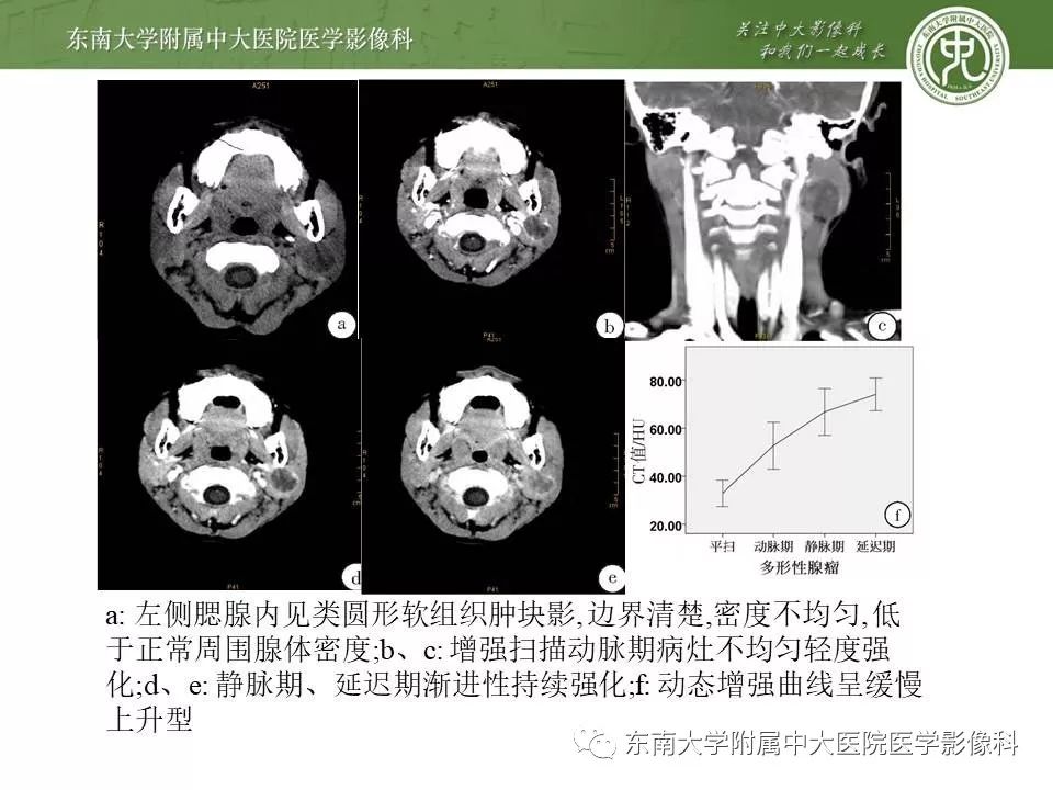【病例】腮腺腺淋巴瘤1例CT及MR影像