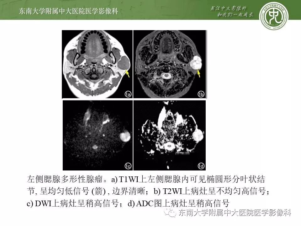 【病例】腮腺腺淋巴瘤1例CT及MR影像