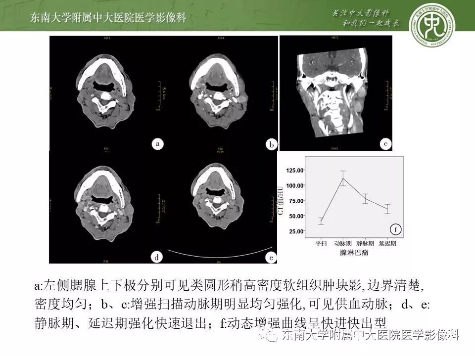 【病例】腮腺腺淋巴瘤1例CT及MR影像