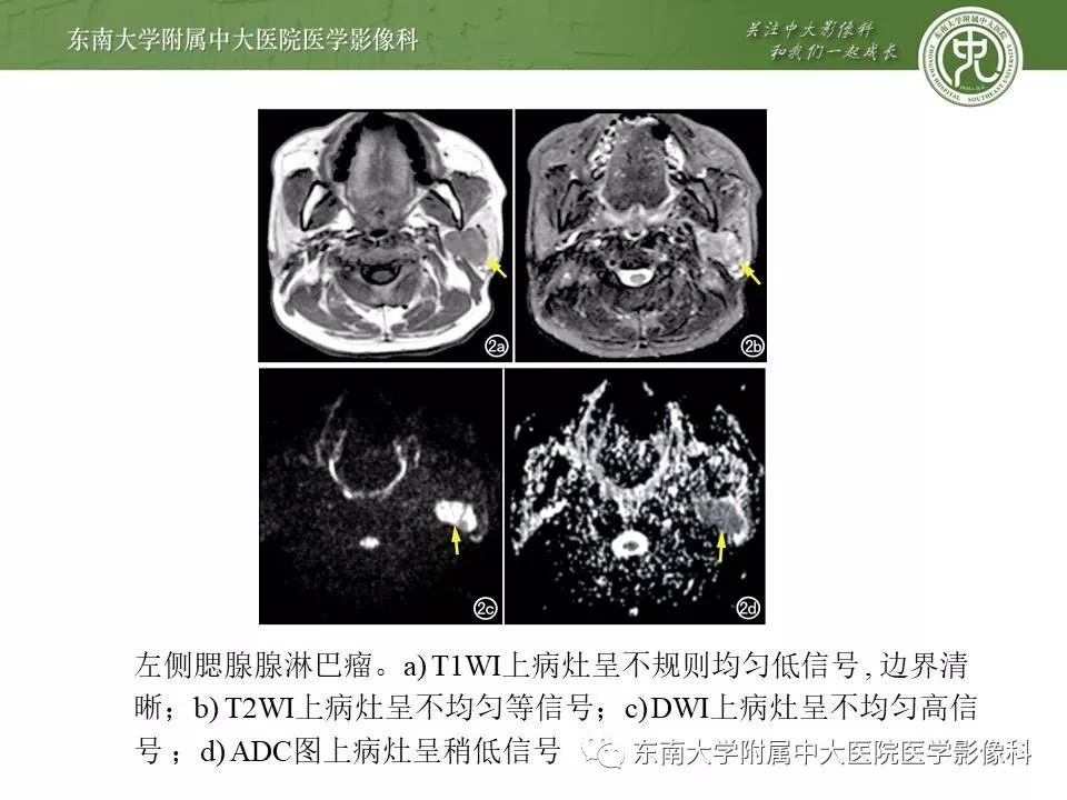 【病例】腮腺腺淋巴瘤1例CT及MR影像