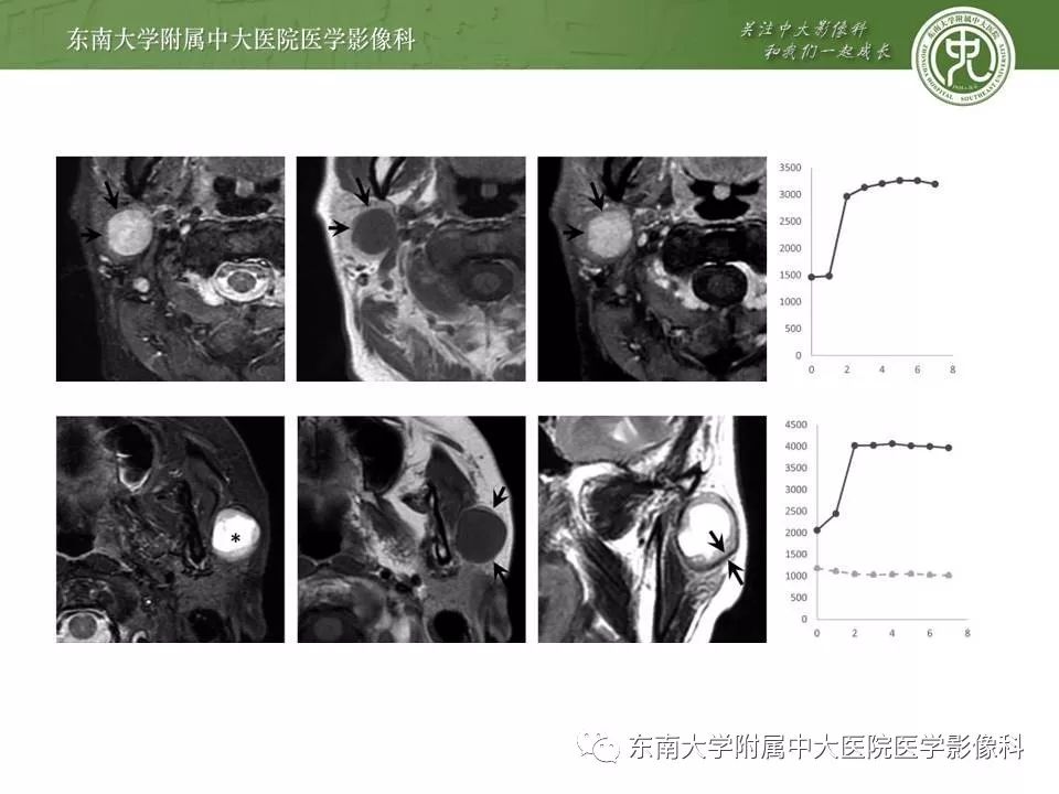 【病例】腮腺腺淋巴瘤1例CT及MR影像