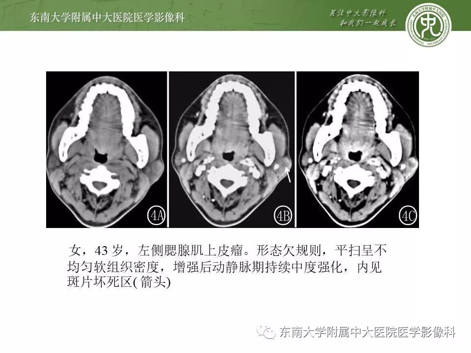 【病例】腮腺腺淋巴瘤1例CT及MR影像